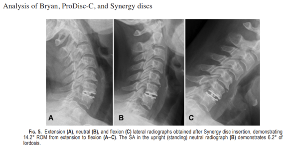 Lazaro, et al. Effect of arthroplasty design on cervical spine kinematics: analysis of the Bryan Disc, ProDisc-C, and Synergy Disc. Neurosurg Focus 28(6): E6, 2010.